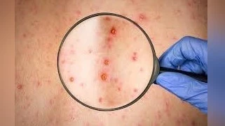 Сегизинчи кырсык лабораториялык изилдөө менен тастыкталды