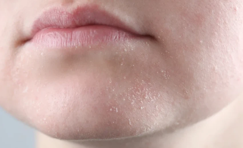 Врач рассказала о связанных с сухостью кожи болезнях